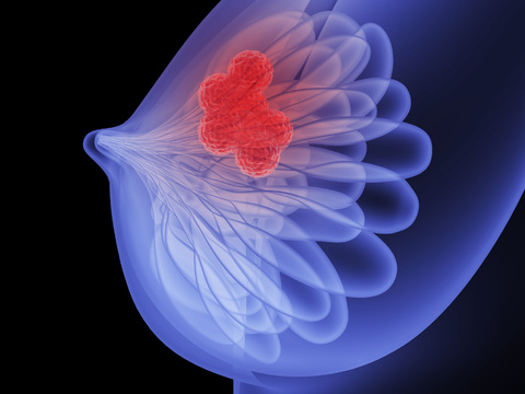  乳腺结节3d模型 