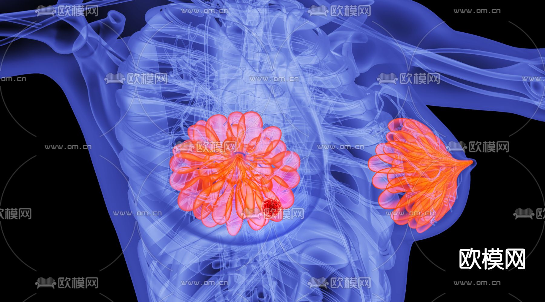 人体乳腺病变场景3d模型下载