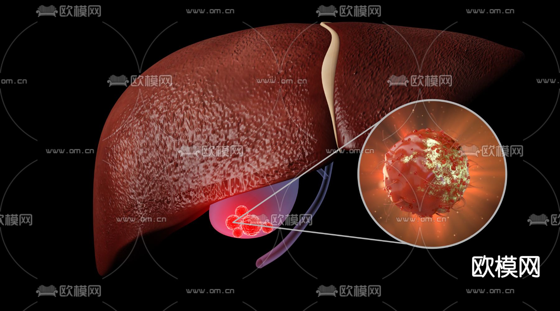 胆结石3d模型下载