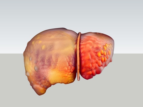 慢性肝病肝脏病变三维可视化su模型