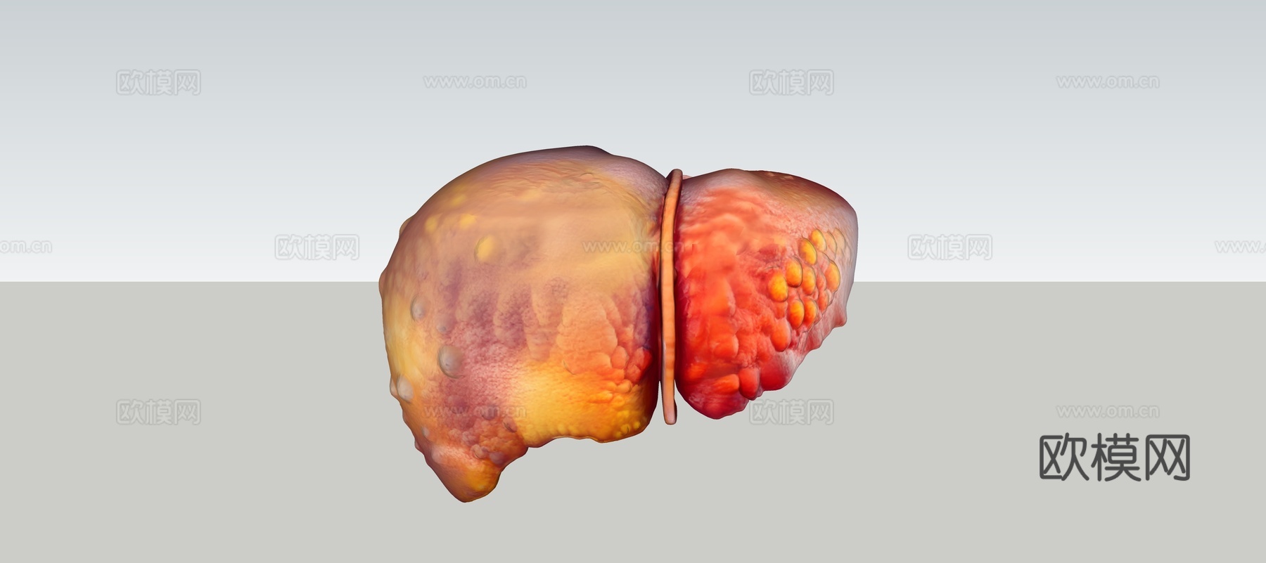 慢性肝病肝脏病变三维可视化su模型