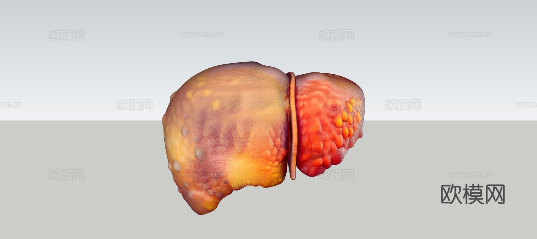 慢性肝病肝脏病变三维可视化su模型